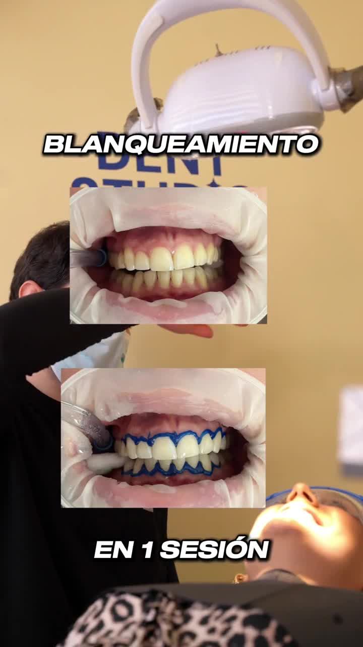 Doble Blanqueamiento